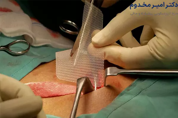 جراحی لاپاراسکوپی فتق