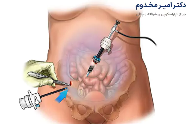 جراحی لاپاراسکوپی چیست