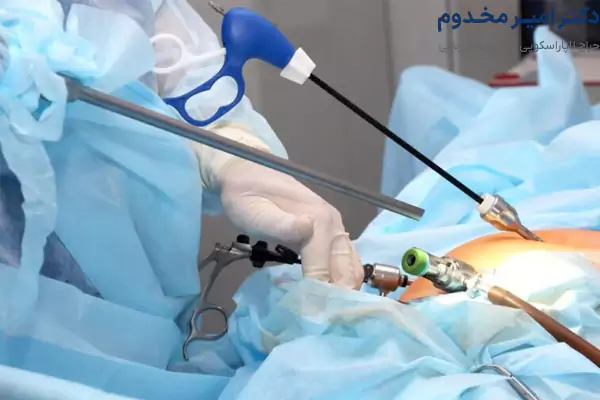 فتق اسپیلگ
