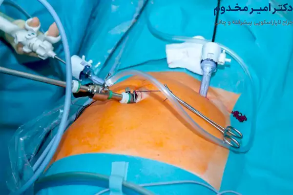 مزایای جراحی لاپاراسکوپی برای تومور شکمی