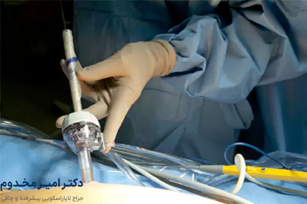 مزایای جراحی لاپاراسکوپی فتق