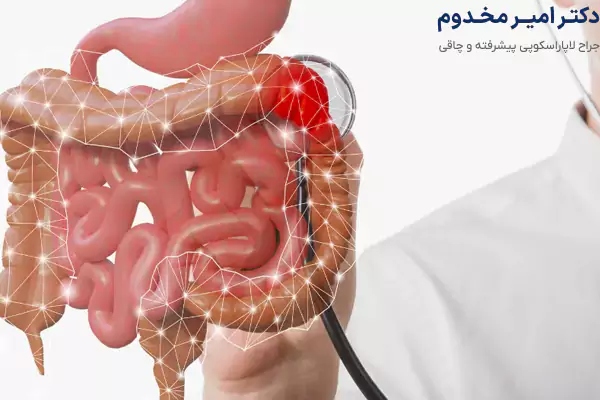 معایب لاپاراسکوپی دستگاه گوارش