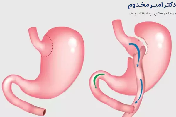 کاندیدای عمل بای پس معده