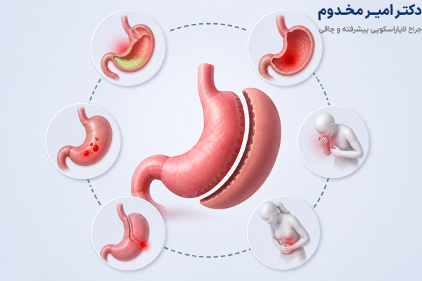 خطر اسلیو معده