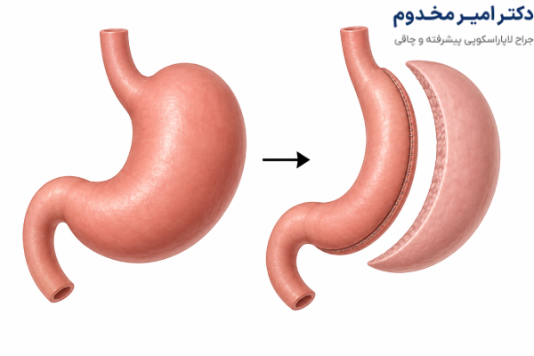 اقدامات بعد از اسلیو معده